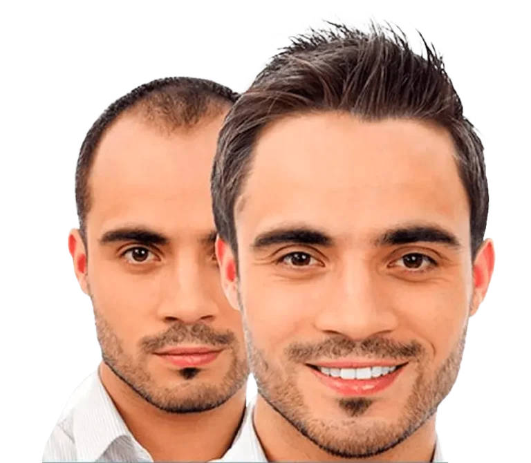 Alopecia por Estrés: Cómo Recuperar tu Cabello Naturalmente